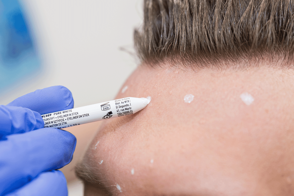 Falten mit Botox behandeln