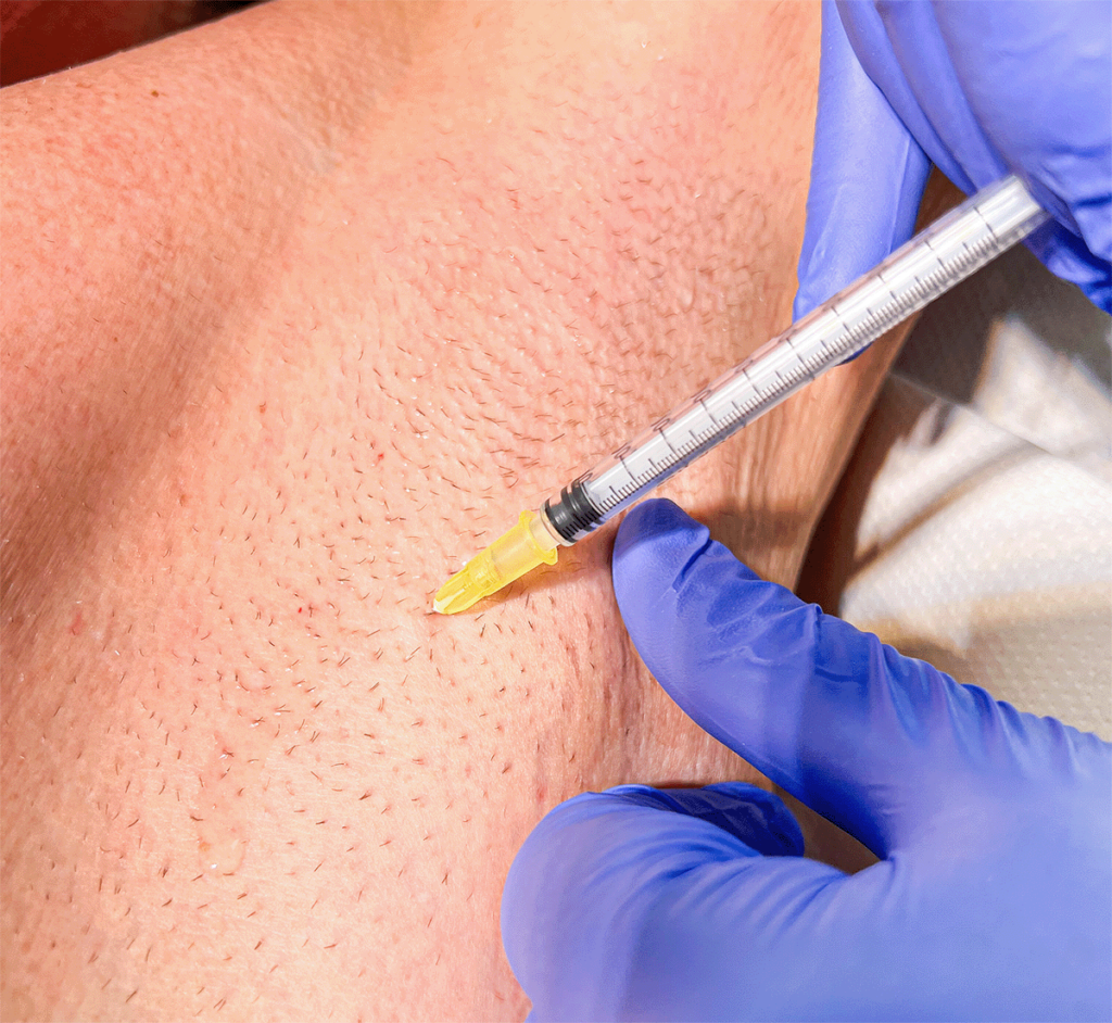 Botox gegen starkes Schwitzen