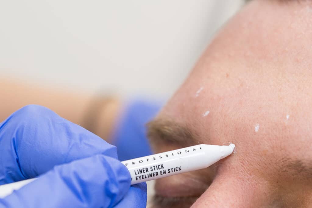 Botox gegen die Zornesfalte